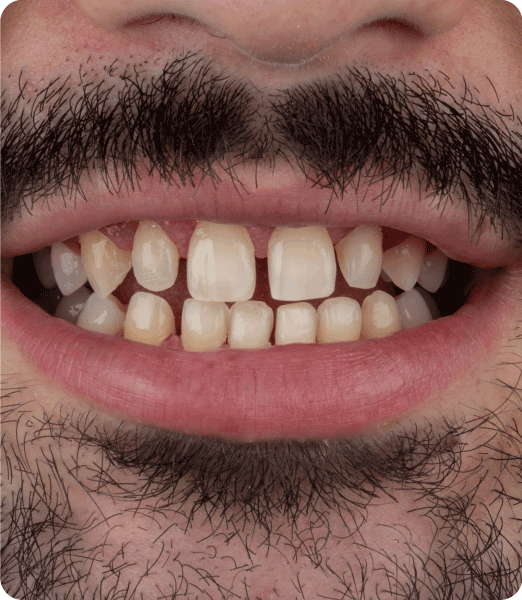 ANTES-Y-DESPUES-PAG2-1